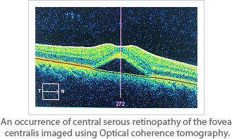 Central serous retinopathy (CSR)