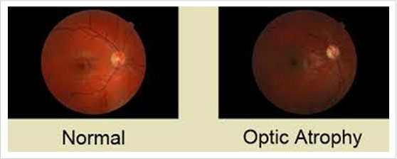 Optic Otrophy