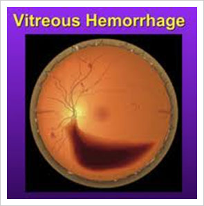 Vetreous Hemorrhage