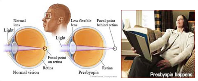 presbyopia
